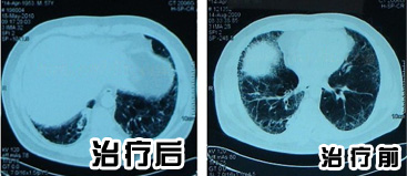 间质性肺炎康复患者ct检查对比片